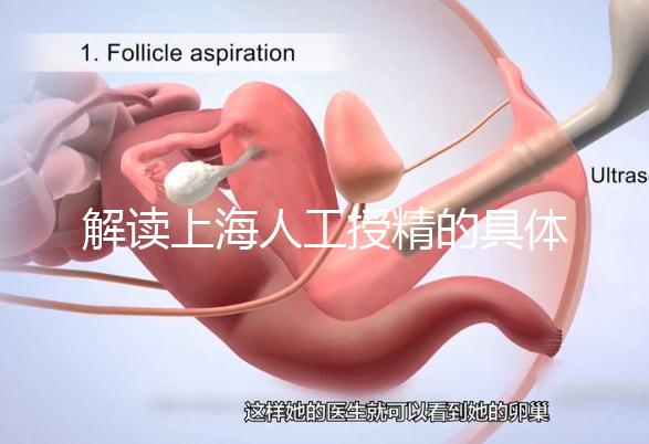 解讀上海人工授精的具體過程，會不會痛看醫生怎么說？