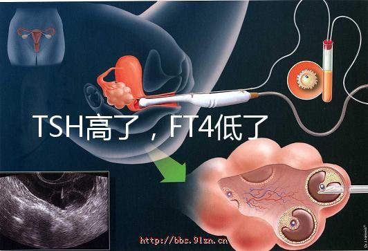 TSH高了，FT4低了，需要補碘嗎？